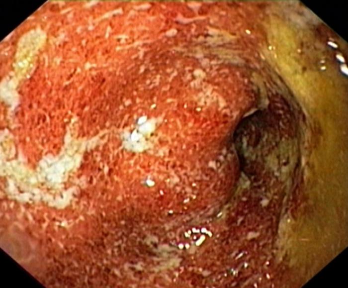 ulcerózní kolitida