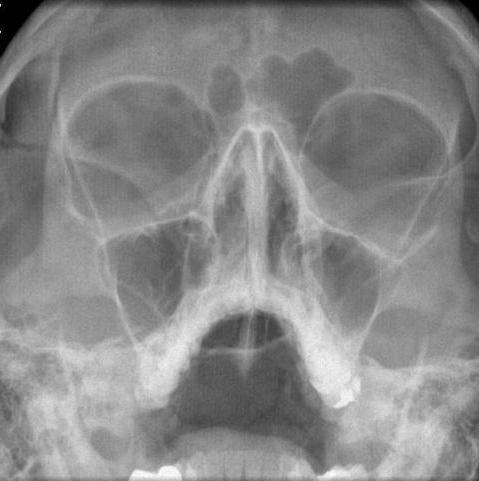 rentgenové snímky paranazálních dutin