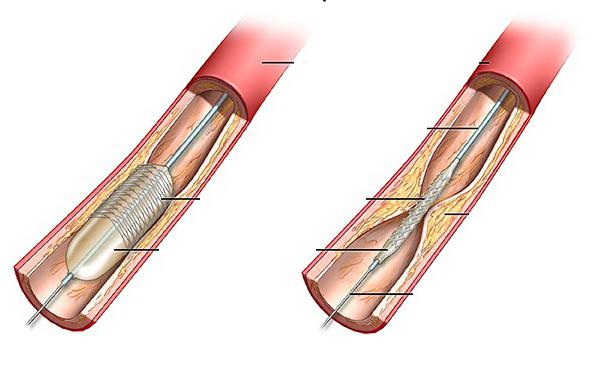 Historie obliterující aterosklerózy dolních končetin