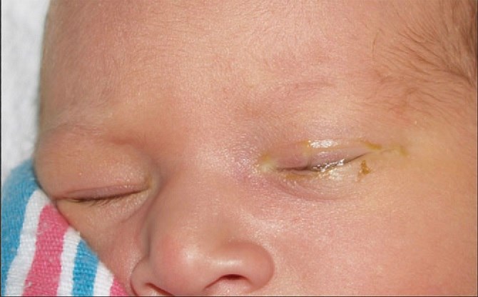 niedrożność kanału łzowego w przeglądzie noworodków