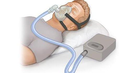 trattamento dell'apnea ostruttiva del sonno