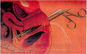 chirurgia del prolasso uterino