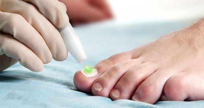 liječenje noktiju onikomikoze