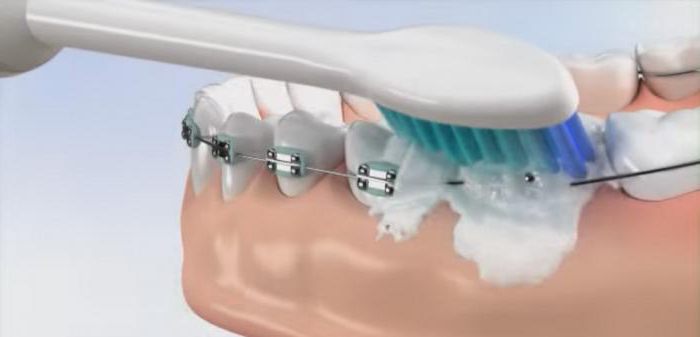 ortodontska zobna ščetka za naramnice