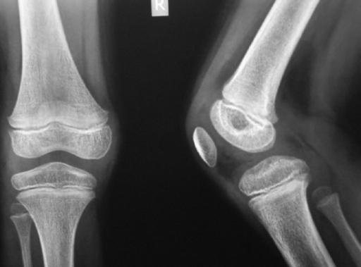 Raggi X dell'articolazione del ginocchio