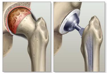 come trattare l'artrosi dell'articolazione dell'anca
