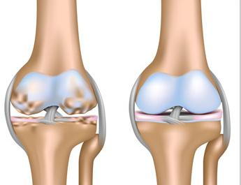 osteoartritis 2. stupnja zgloba koljena