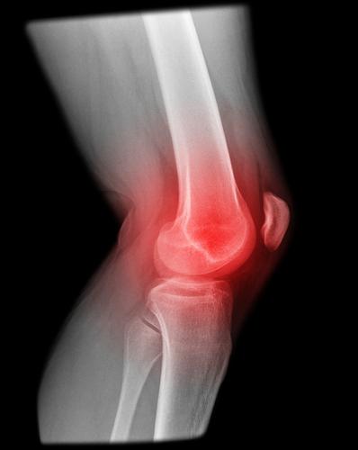 остеоартритис зглоба колена ИЦБ 10