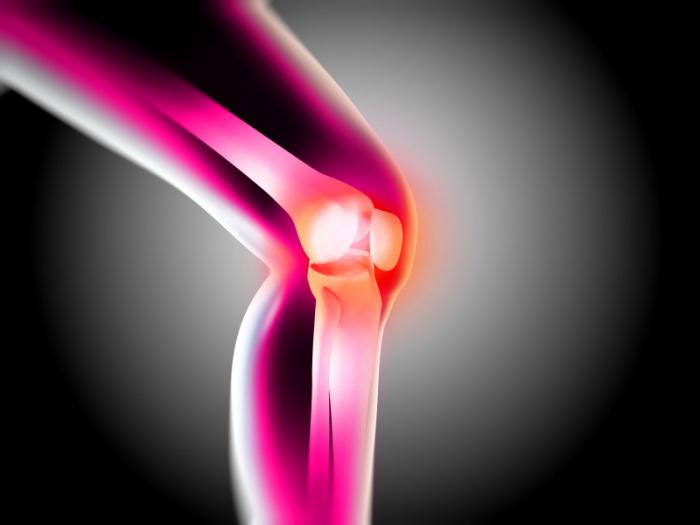 Osteoartritis koljena: stupanj bolesti, simptomi. Liječenje osteoartritisa koljena