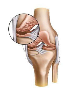 posttraumatska artroza liječenja koljena 3 stupnja)