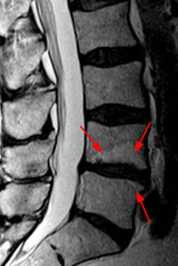 лумбална остеохондроза на гръбначния стълб