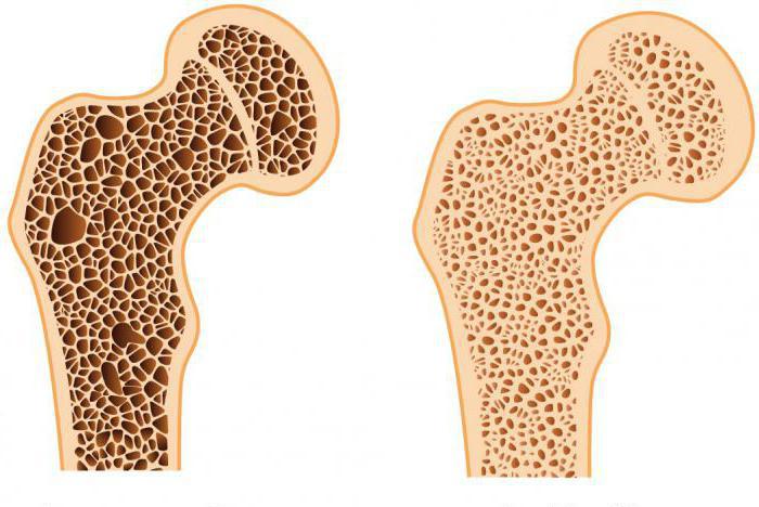 malattia da osteoporosi