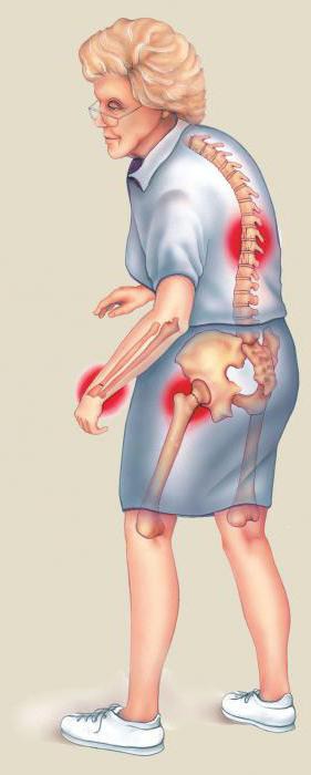osteoporóza kostí