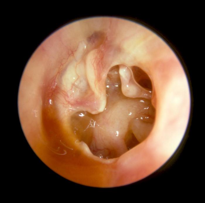 третман отисака уха