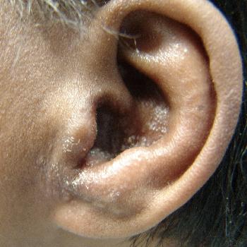 kako zdraviti vnetje ušesa