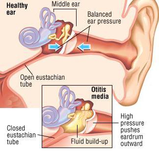 zapalenie ucha środkowego