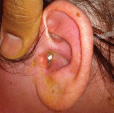 akutno gnojno vnetje srednjega ušesa