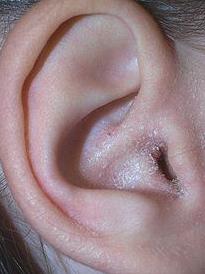 Przewlekłe zapalenie ucha