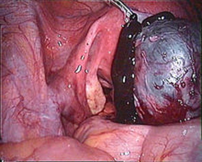 simpotomia apoplessia ovarica