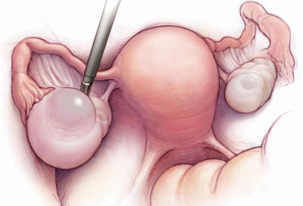 ovariální cysta laparoskopie