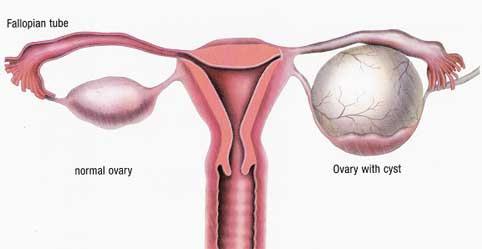 sintomi di rottura della cisti ovarica
