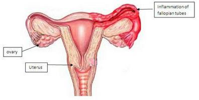 příznaky zánětu vaječníků