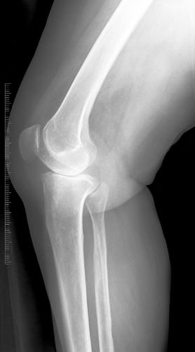 bolečina pod kolenom