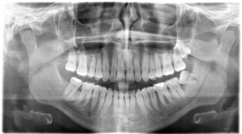 panoramatický záběr zubů