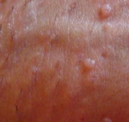 papilloma in luogo intimo