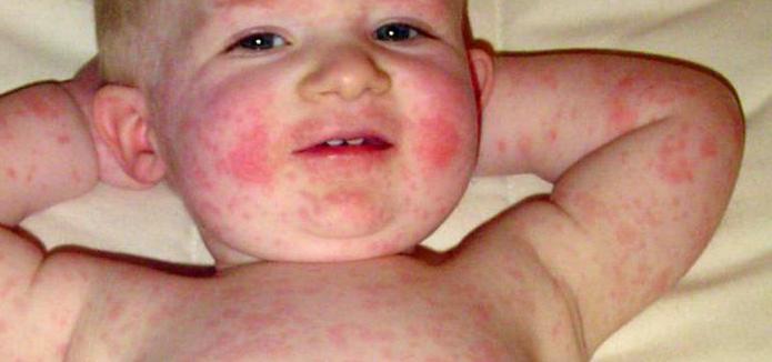 infezione da parvovirus nei bambini