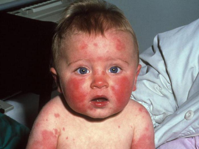 инфекција парвовирусом код деце на фотографији осипа код деце