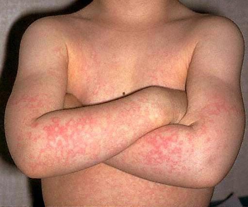 parvovirovou infekcí u dětské foto vyrážky