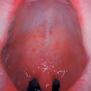 infekcja parwowirusem u dzieci objawy zdjęcie początkowej fazy