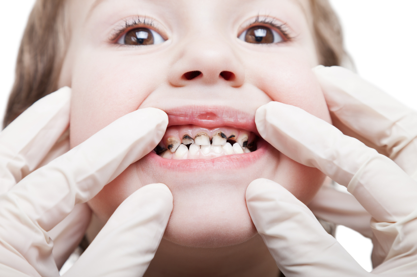 Зъбите на детето се влошават