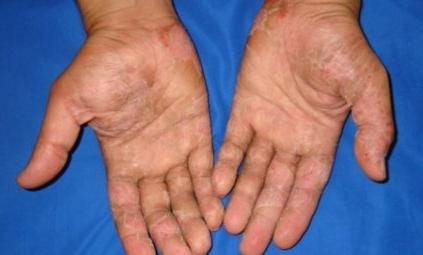 obieranie skóry na palcach