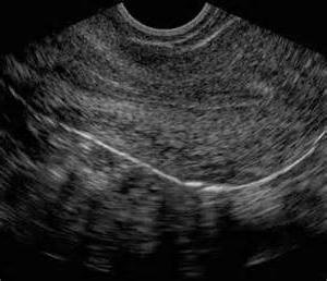 ultrazvuk pánevní přípravy během těhotenství