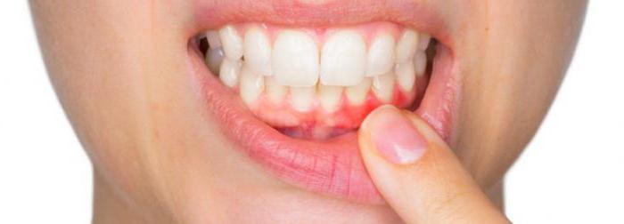 parodontalne bolezni, kaj je to