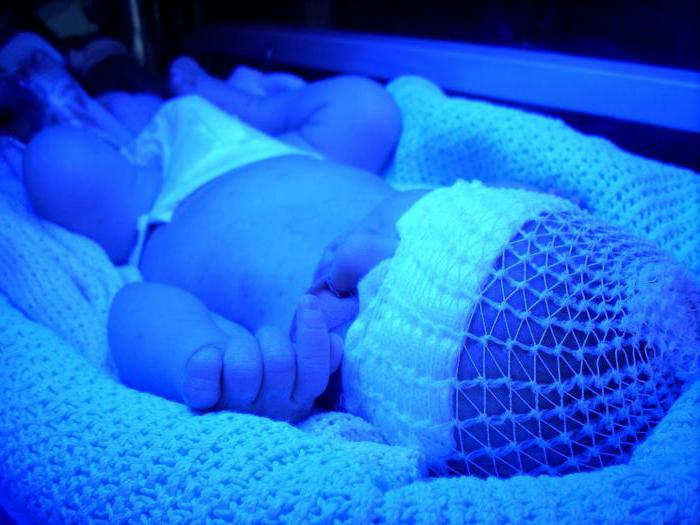 fototerapia per i neonati