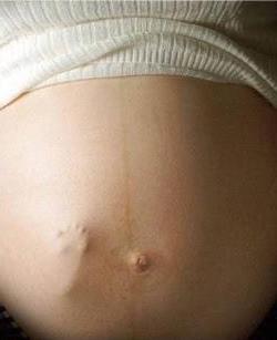 Belly pás během těhotenství