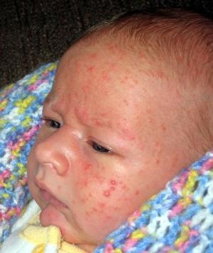 akne na obrazu za dojenčke