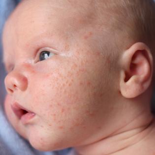 alergický na tvář dítěte