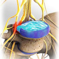 přichycení léčby homeostázním nervem