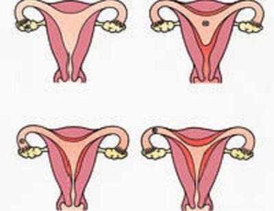 Růžový výtok po menstruaci