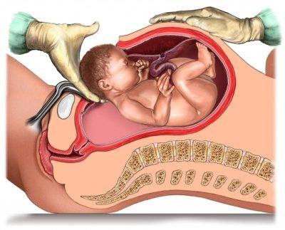 placenta sulla parete frontale dell'utero