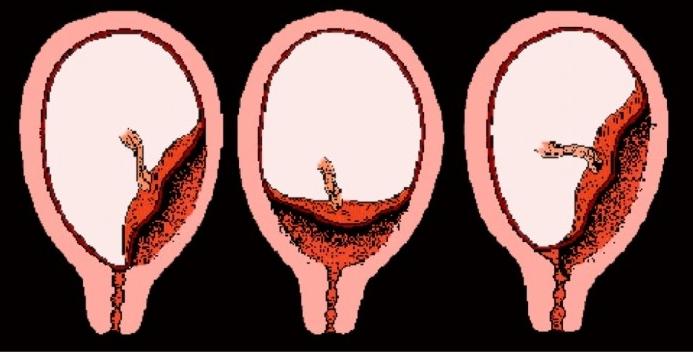 placenta previa příznaky