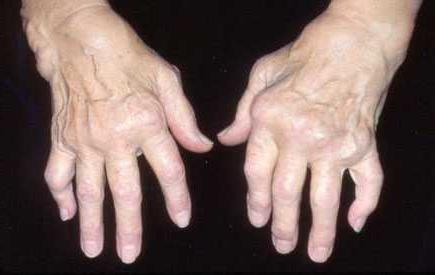 artritis zglobova