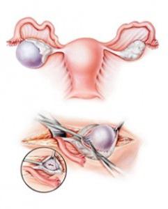 polycystických vaječníků a těhotenství
