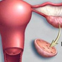 polycystická ovariální léčba lidových léků