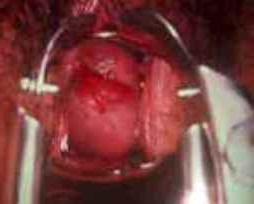 polipi nel trattamento dell'utero