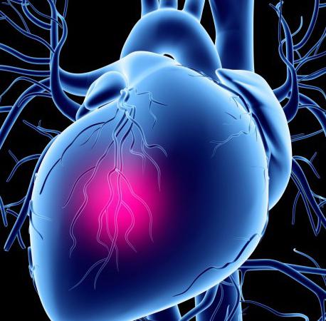 postinfarktna kardioskleroza